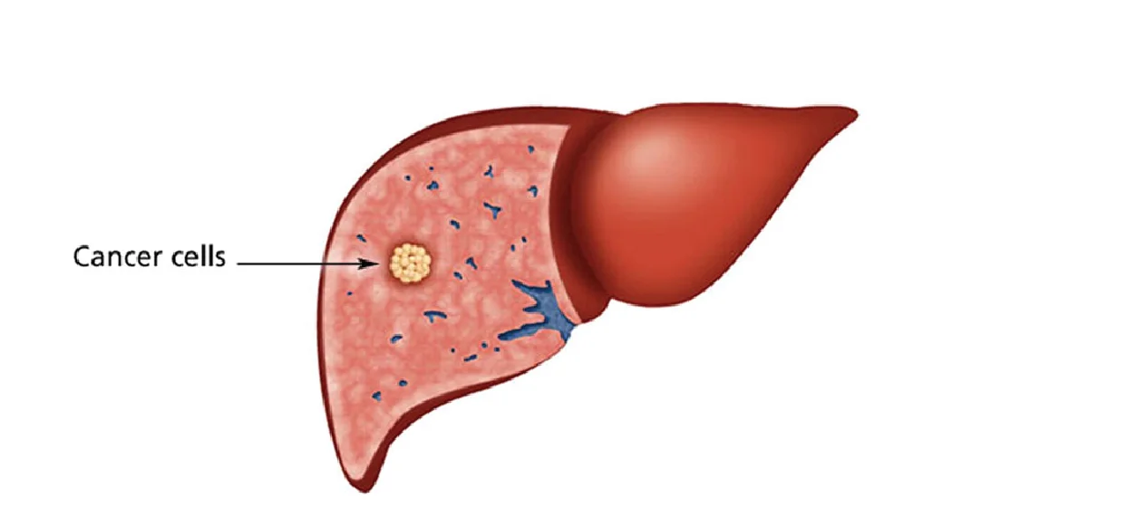 All You Need to know About Liver Cancer and Its Treatments